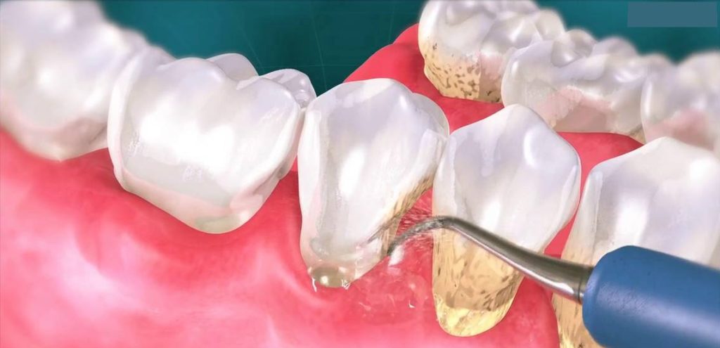Profilaxie si estetica dentara Pitesti